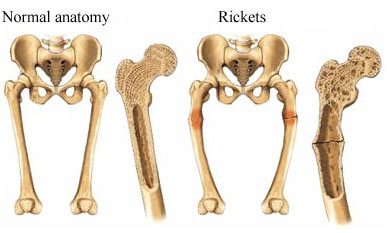 Study Finds Internet Generation At Risk of Rickets